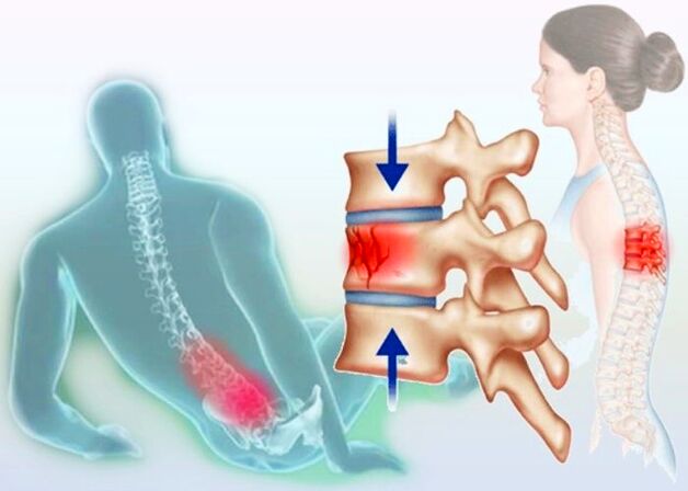 Och eng gewéinlech Verletzung kann d'Entwécklung vun Osteochondrose ausléisen