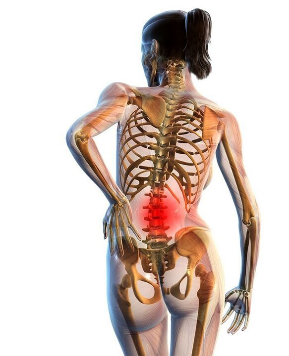 Osteochondrose vun der Lendegerwirbelsäule geschitt am meeschten