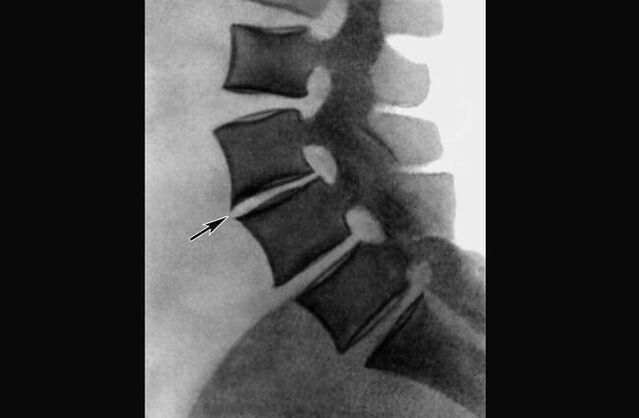 Manifestatiounen vun Osteochondrose vun der thoracic Wirbelsäule op engem Röntgen